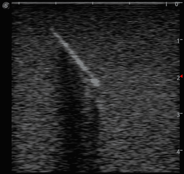 Foreign Body Ultrasound Training Model